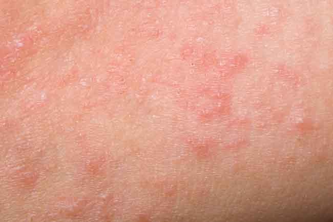 effective-home-remedies-for-hives-in-hindi